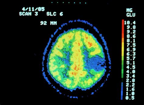 Coloured Pet Scan Of The Brain Showing A Tumour Photograph By National