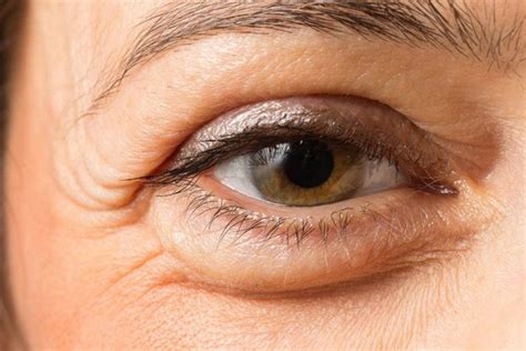 Swollen Eyelids Causes And Treatments The Eye News