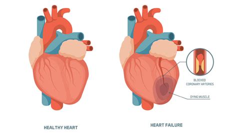 What Are The Four Stages Of Congestive Heart Failure Entirely Health