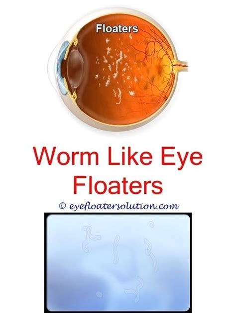 I Got Rid Of Eye Floaters Other Causes Of Eye Floaters Nutrients Good