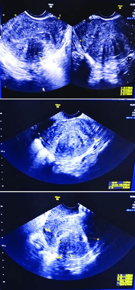Transvaginal Ultrasound Shows Submucosal Uterine Fibroid With Size 34
