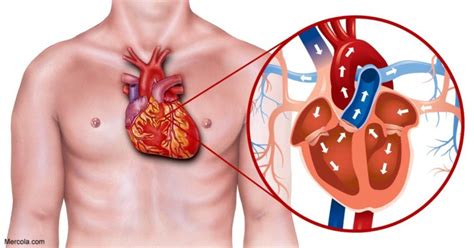 How Is Heart Blockage Treated