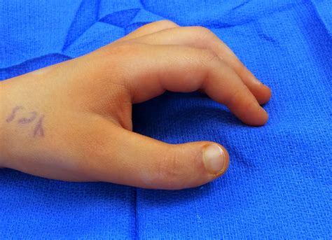 Triphalangeal Thumb Congenital Hand And Arm Differences Washington University In St Louis