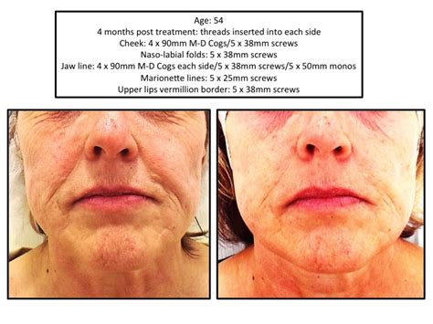 Before And After Side Image Preston Skin And Laser Clinic