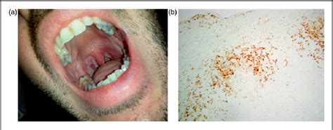 Syphilis Chancre