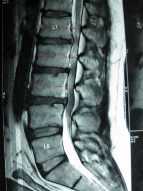 spinal stenosis mri