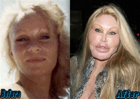Top 10 Extreme Plastic Surgery Before And After Plastic Surgery Facts