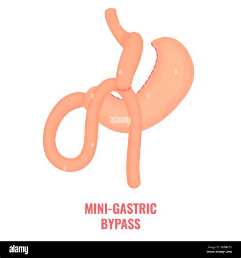 Mini Gastric Bypass Bariatric Surgery Illustration Stock Photo Alamy