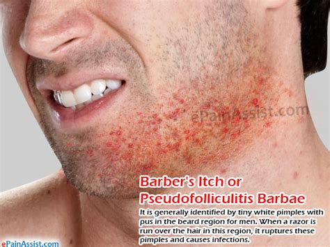 Barbers Itch Or Pseudofolliculitis Barbaetypescausestreatment