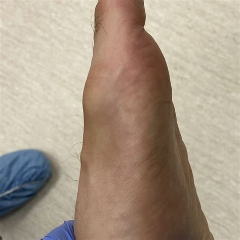 Skin Cancer And Your Feet Dr Nicholas Campitelli