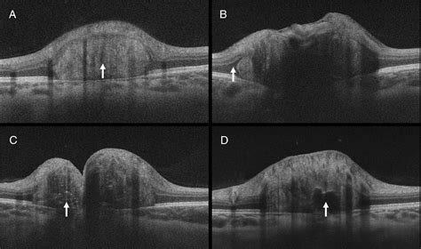 Utility Of Spectral Domain Oct In Differentiating Optic Disc Drusen