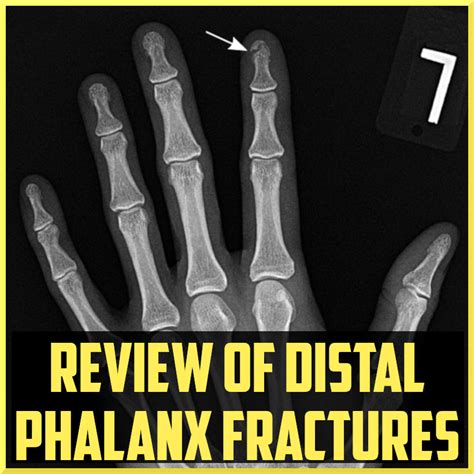 Review Of Distal Phalanx Fractures Sports Medicine Review
