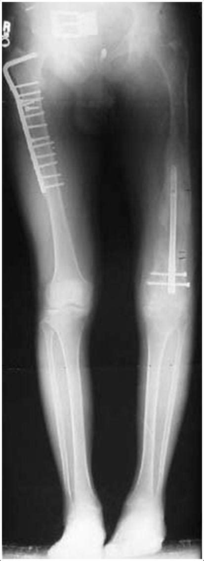 One Leg Shorter Than The Other After Femur Fracture Pictures