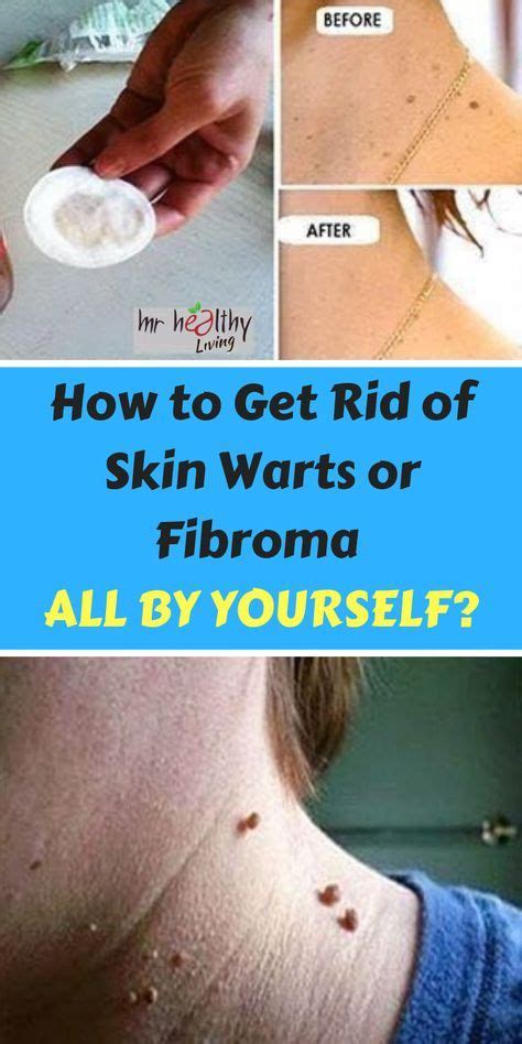 Heres How To Get Rid Of Skin Warts Or Fibroma With Ease Warts On Face