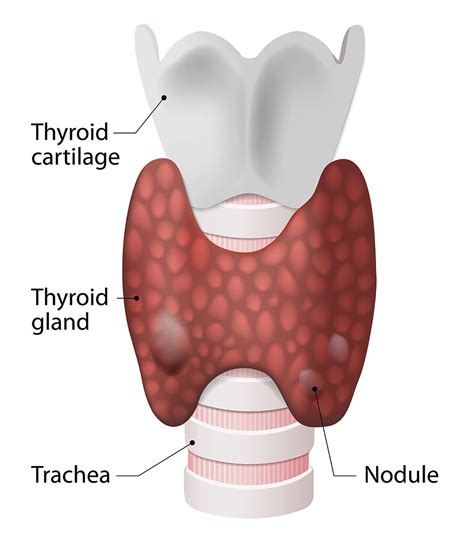 Thyroid Nodules And Thyroid Surgery Brisbane — Sunnybank Surgical Group