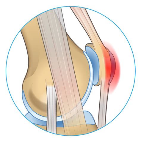 Knee Pain On The Front Of Your Joint Learn Why Spring Loaded Technology