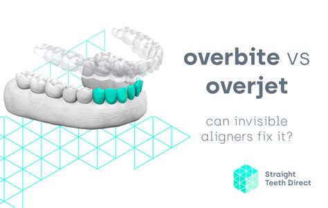 Overjet Vs Overbite What Is What And Can Aligners Improve Them