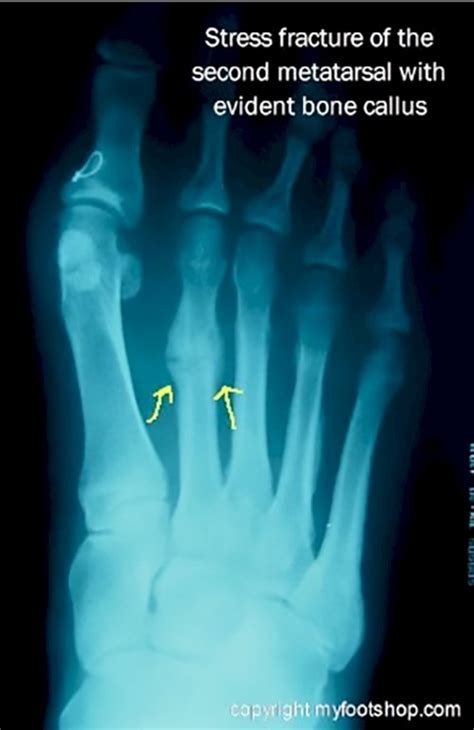 Metatarsal Fractures Causes And Treatment Options