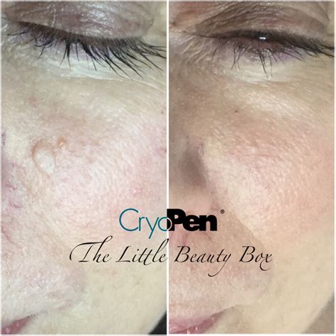 Cryopen Skin Blemish Removal The Little Beauty Box Lowton