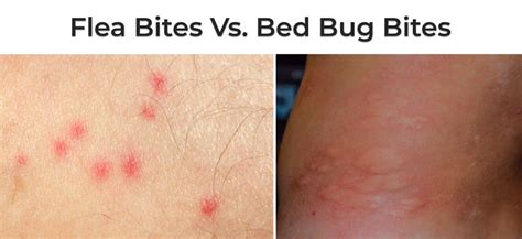 Flea Bites Vs Bed Bug Bites Different Symptoms Treatments