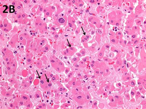 Tumour Cells Exhibited Hyperchromatic Nuclei Irregular Raisindoid