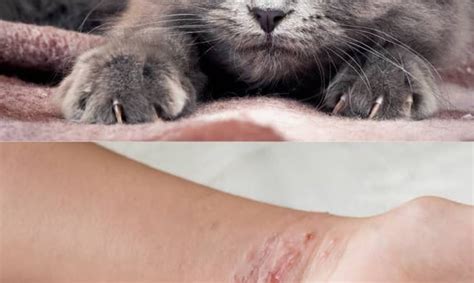 Cat Scratch Disease Causes Symptoms And Treatment Pro Health Tips
