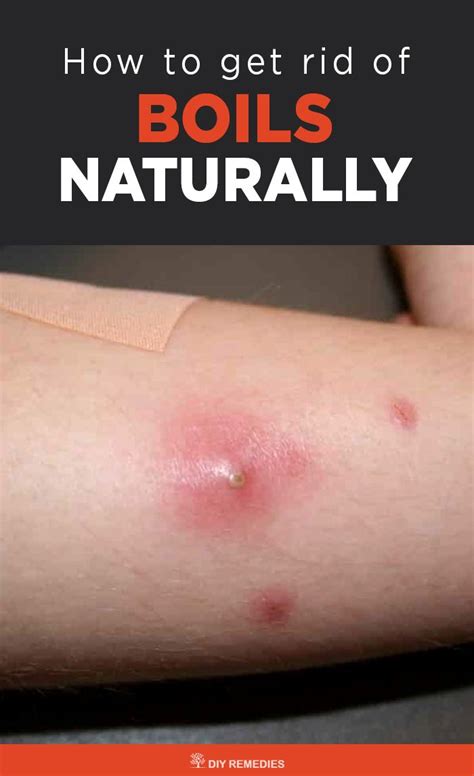 Home Remedies To Get Rid Of Boilsalways Remember That These Boils Are