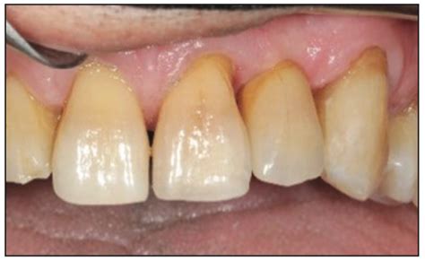 Minimally Invasive Bonded Bridges Vs Implants Dentistry Today
