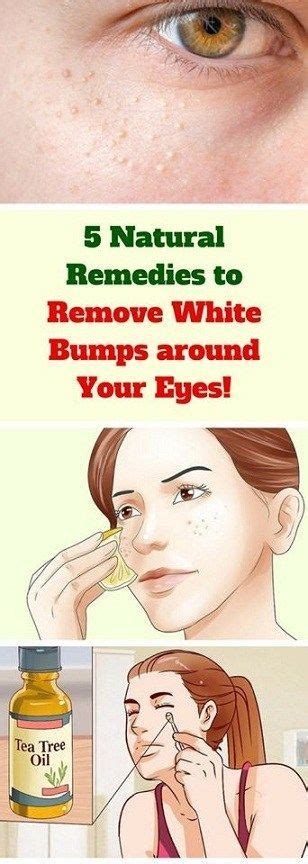 5 Natural Remedies To Remove White Bumps Around Your Eyes Beauty