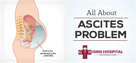 Ascites What Are Its Causes Symptoms Diagnosis And Treatment Options