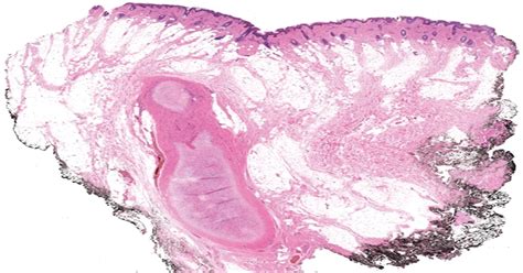 Cervical Chondrocutaneous Branchial Remnant A Case Report A The