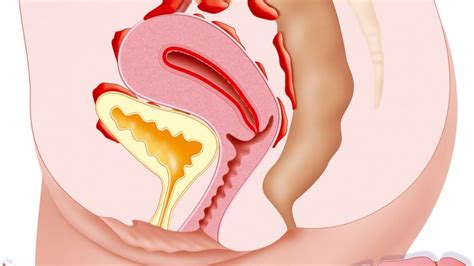 Read about the causes for the development of endometriosis, a disease that affects the female reproductive system, causing pain and infertility. In light of Lena Dunham's decision to get a hysterectomy | GMA