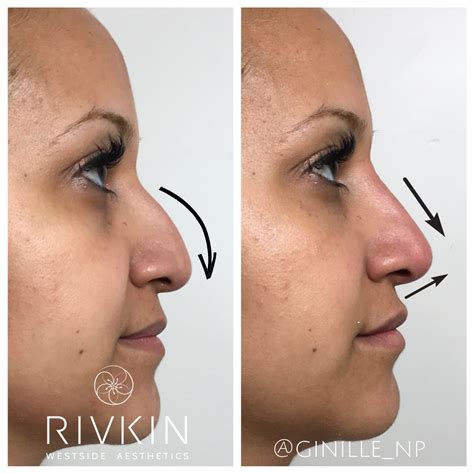 Pin On Dr Rivkins Non Surgical Nose Job