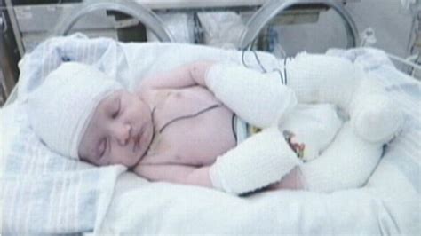 Baby Born Without Skin Video Abc News