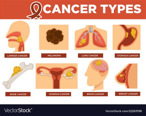 Cancer Types Poster With Kinds Disease Royalty Free Vector