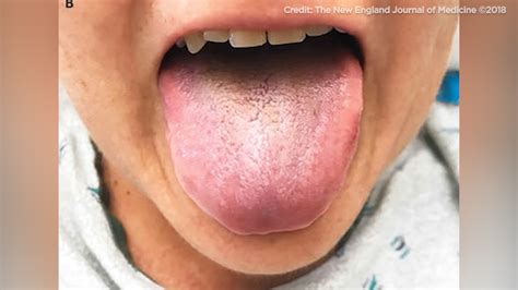 Woman Develops Black Hairy Tongue After Being Treated With