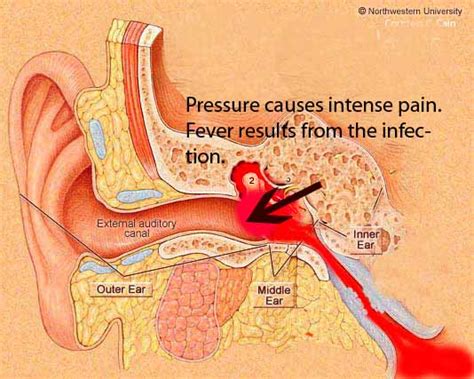 Ear Infections Middle Ear Infections Glue Ear Serous Otitis