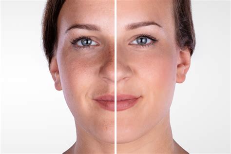 Microdermabrasion Results Benefits How To Maintain Before And Afters
