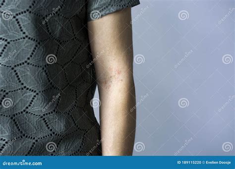 Itchy Red Bumps On Crook Of Arm Elbow Irritated Skin Rash Stock Photo