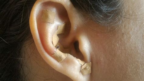 Ear Seeds Are Tiny Acupressure Devices That Involve No Needles