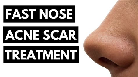 Fast Nose Acne Scar Treatment 100 Works Get Rid Of Acne Scar