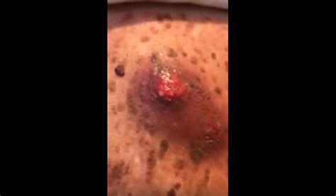 Biggest Cyst Popped On Back New Pimple Popping Videos