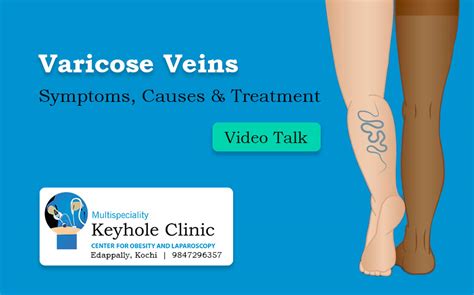 Laser Treatment For Varicose Veins In Kerala Keyhole Clinic Kochi