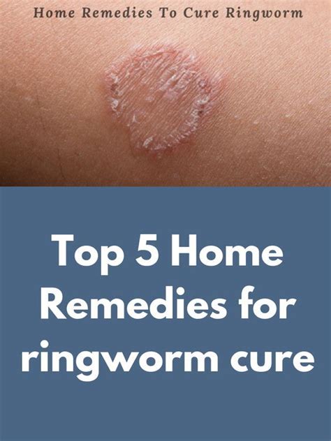 Does Hand Sanitizer Kill Ringworm How To Get Rid Of Tinea Versicolor