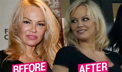 Pamela Anderson Plastic Surgery Makeover Top Docs Tel All
