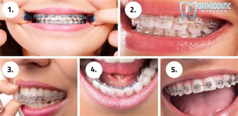 Different Types Of Braces Favourite Dentistry