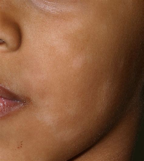 An Approach To Hypopigmentation The Bmj