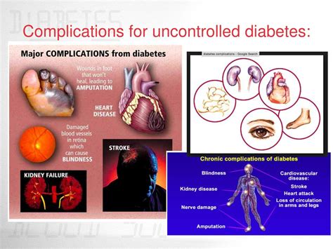 Powerpoint Presentation On Diabetes Mellitus