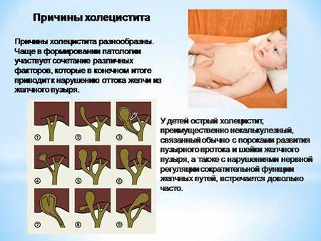 Холецистит удаление диета Холецистит: симптомы, лечение взрослых и детей, диета, признаки, причины Холецистит: симптомы, лечение взрослых и детей, диета, признаки, причины Холецистит удаление диета