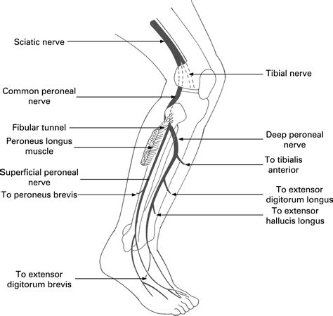 Common Peroneal Nerve Lesions Vrogue Co